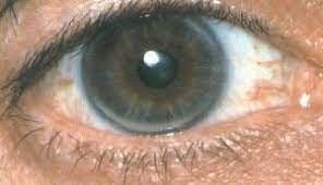 Seeing The Signs Of High Cholesterol Allegro Optical