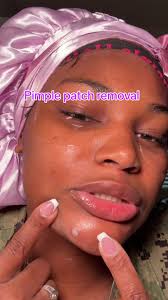 #fyp #acneskincare #pimplepatch #removal #extractions