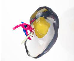 When malignant cancer cells form and grow within a person's breast tissue, breast cancer occurs. Collaborative Clinical Study Aims To Advance Treatment Of Kidney And Prostate Cancer With 3d Printing 3printr Com