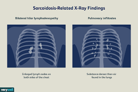 From my experience being diagnosed with lung cancer which fortunately turned out to be sarcoidosis of the lungs , then four years later suspected lymphoma when i had swollen lymph nodes in my neck. Sarcoidosis Overview And More