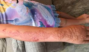 Henna Tattoo Leaves Girl 7 With Horrific Chemical Burns And Scars World News Express Co Uk Danish zehen tattoo meaning ___it's all tattoo secret ___you should know ___it's not bad. henna tattoo leaves girl 7 with