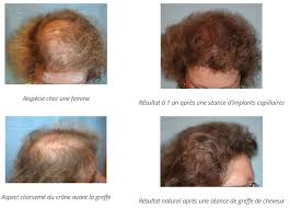 L'alopécie, du grec « alopex », désigne la perte partielle ou totale des cheveux. Avvertimento Centesimo Ringraziamento Chute De Cheveux Femme Jeune Lepre Ciclo Continuo Vedere