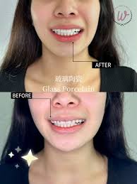 水晶瓷牙