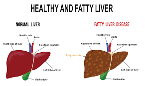 Fatty Liver Healthdirect