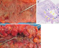 The colon, or large intestine, is a. Colon Cancer Arising From Colonic Diverticulum A Case Report