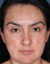 Treating Epidermal Melasma With a 4% Hydroquinone Skin Care System Plus  Tretinoin Cream 0.025%