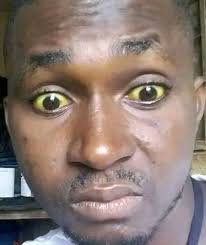 LIVER PROBLEMS TREATMENT The liver is a vital organ that supports nearly  every other organ to some capacity and you cannot live without a healthy  liver.The liver is the body's second-largest organ