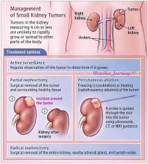 Read More And Download Book Immediately Management Of Small Kidney Tumour Medico Medical Paschool Medicalschool M Kidney Tumor Surgery Nursing Tumor
