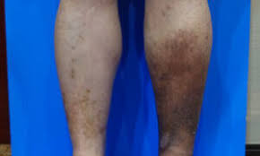 Image result for Lipodermatosclerosis