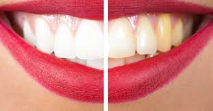 However, i suspect the chlorine kills the bacteria or changes the mouth flora. How To Get Rid Of Yellow Teeth 11 Home Remedies