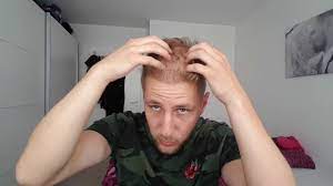 Nach der frühen heilungsphase kann man das wachsen der haare beobachten, allerdings sollte man sich nicht beunruhigen lassen, wenn die neuen haare innerhalb der ersten drei monate ausfallen. Haartransplantation Erfahrung Wachsen Die Haare Hinten Nach Youtube
