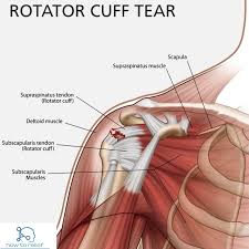 In fact, rotator cuff tears become a normal finding as people get older. Rotator Cuff Tear Symptoms Causes Diagnosis Treatment Exercises How To Relief