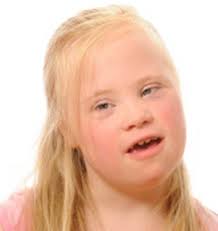 Epicanthal folds occur commonly in infants and may persist in persons of certain ancestries. This Girl With Down Syndrome Has Almost No Epicanthal Folds Very Mensen