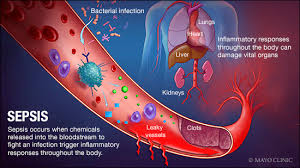Read about symptoms, treatment and risk factors for sepsis. Sepsis Complications How Nursing Homes Should Prevent Treat Dinizulu Law Group Ltd