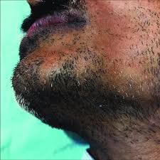 Its progression is often sporadic and can seem capricious. Clinical Image Of Alopecia Areata Affecting The Beard Note The Download Scientific Diagram