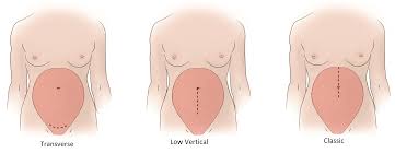 Cesarean Section Chapter 34 Atlas Of Surgical Techniques In Trauma