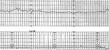 Image result for icd 10 code for no fetal heart tones