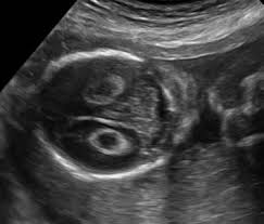 Club foot is diagnosed at birth and may be diagnosed earlier, during pregnancy, or through ultrasound. Controversial Ultrasound Findings In Mid Trimester Pregnancy Evidence Based Approach