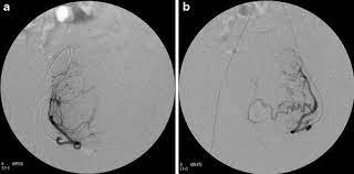 Embolotherapy occlusion of arteries by insertion of blood clots,gelfoam, coils, balloons, etc., with an angiographic catheter; Embolotherapy In The Management Of Gynecologic Neoplasms Springerlink