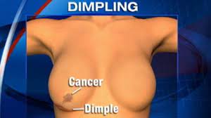With this type of cancer, rather than forming a tumor, the cancer cells block the lymphatic vessels. Dimpling Skin Could Be A Sign Of Breast Cancer Video Abc News