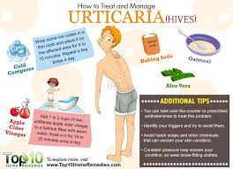 How To Treat And Manage Urticaria | Top 10 Home Remedies | Urticaria, Hives  Remedies, Home Remedies For Hives