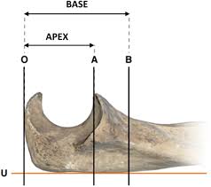 Image result for Coronoid Process Fracture