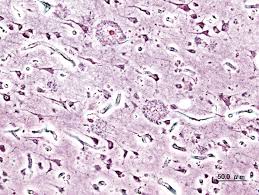 Fast visualization in thick sections. Senile Plaques Wikipedia