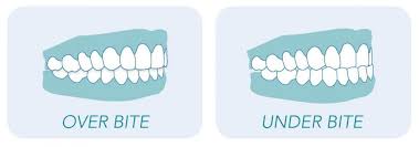 Invisible braces is the common vernacular for what's really called clear aligners.. Everything You Need To Know About Overbites And Underbites
