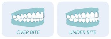 In fact, improvised treatments may even aggravate the patient's condition. Everything You Need To Know About Overbites And Underbites