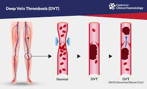 Deep Vein Thrombosis Dvt Cfch Centre For Clinical Haematology