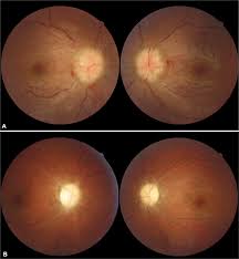 Image result for Pseudoeriosema