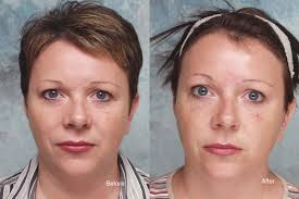Dysport may be used too. Botox Case Studies Beverly Hills Dysport Beverly Hills Lidlift