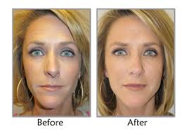 Medical spas, cosmetic surgeons, laser hair removal. Get Beautiful Results With Our Non Surgical Facelift At Ageless Splendor Now Only 700 Nonsurgicalfacelift Dublinohio Botox Botox Injections Perfect Skin