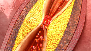 To prevent clogged arteries, less than ten percent of your calories should come from saturated fat i received a scan on my neck and it came back 50 percent blocked on the right and left side. Clogged Arteries Signs And Symptoms Of Arterial Plaque