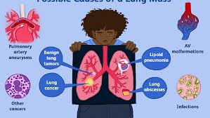 What is carcinoma or adenocarcinoma? Possible Causes Of A Lung Mass