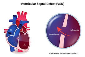 Image result for Ventricular Septal Defect