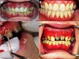 Image result for Gingivitis