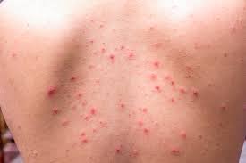 At night, a clay mask can help draw out blemishes, says. How To Get Rid Of Back Acne 3 Methods Vargas Face And Skin Center
