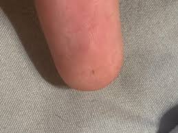 I had little bugs crawling on me, in my hair and in my clothes. Identifying A Tiny Bug The Keeps Crawling On My Skin Thriftyfun