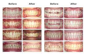 Even without orthodontic coverage, which can be expensive on its own, there are other ways to save on orthodontic costs. Affordable Braces Las Vegas Starting At 89 Mo Absolute Dental Orthodontics