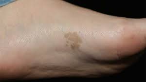 Image result for Pigment stains on the shin