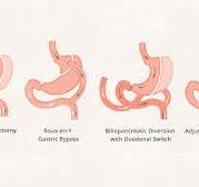 Bariatric Surgery: How It Works, Benefits, Foods, and More
