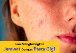 Berikut Cara Menghilangkan Jerawat Dengan Pasta Gigi Yang Efektif Edisutanto Com