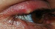 Treatment Options For Swollen Eyelids