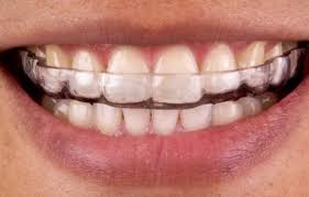 12 to 22 hours for the first 3 to 6 months after treatment night time only for the next 6 to 12 months and beyond Invisalign Care Tips