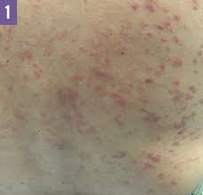 Syphilis syphilis is an std caused by a bacterium called treponema pallidum. Chronic Urticaria Associated With Helicobacter Pylori Infection Infectious Diseases