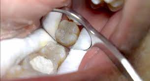 Hai gengs minggu ini kita bahas tentang pemasangan gigi palsu menggunakan bpjs yaa semoga bermanfaat, thanks happy watching gengs. Pengalaman Pasang Gigi Palsu Pakai Bpjs 2021