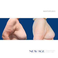 Concepts And Principles Of Breast Reduction Surgery | Springerlink