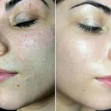 Piel opaca y sin brillo...? NO MAS. llámanos 809-242-1115 y pondremos tu  piel super glowing.