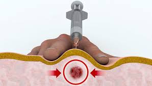 Image result for Tender Point